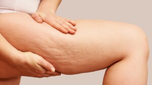 cellulite right thigh