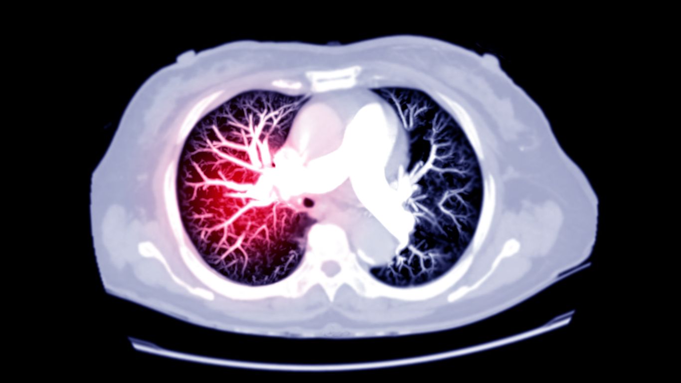 Ct scan picture for a blog on pulmonary embolism