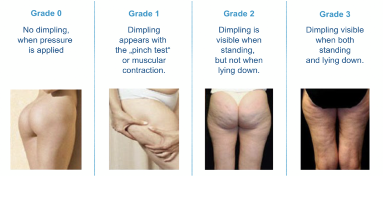 grade of cellulite