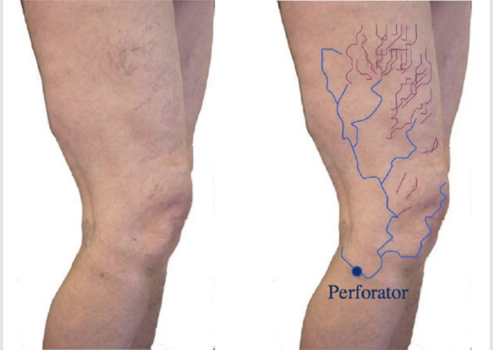 albenese pattern thigh