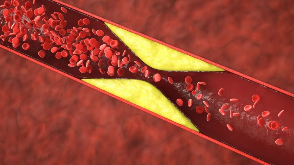 arterial blockage