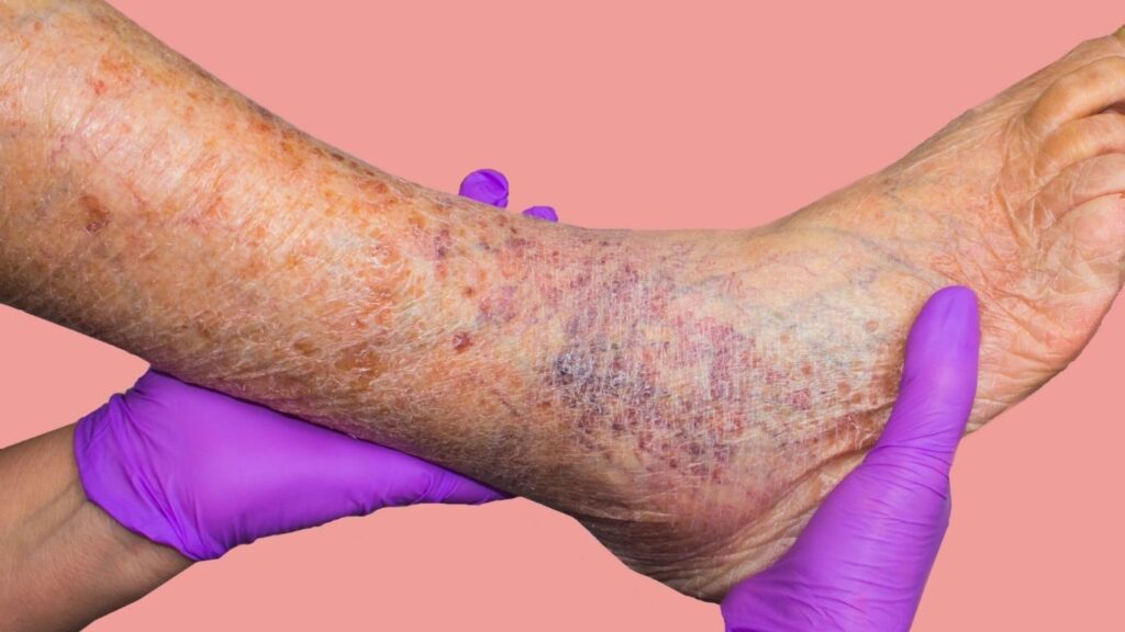 signs of chronic venous disease on the ankle