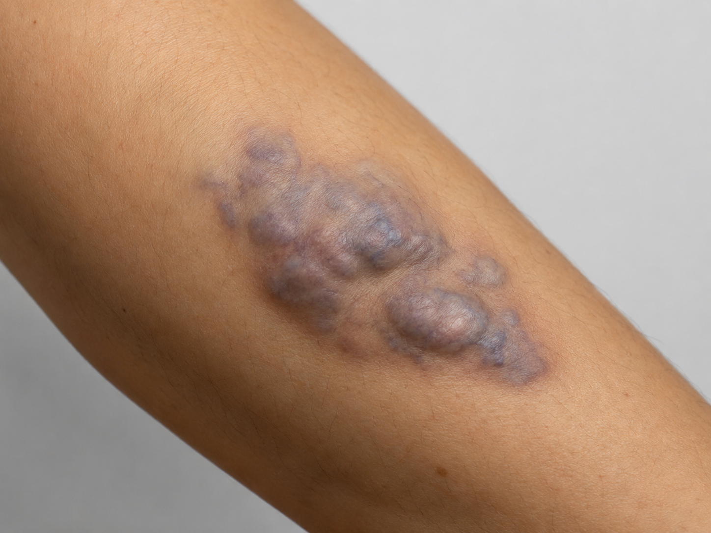 venous malformation